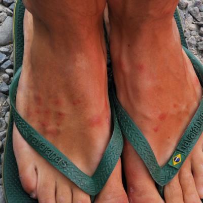 Piqures de Sandflies